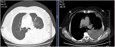Pleural involvements in pulmonary sarcoidosis: A case report and review of the literature